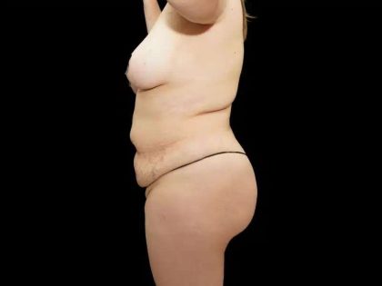 Tummy Tuck Before & After Patient #400