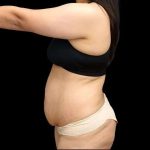 Tummy Tuck Before & After Patient #407