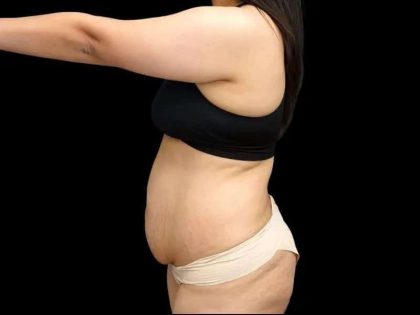 Tummy Tuck Before & After Patient #407