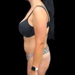 Liposuction Before & After Patient #451