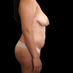 Mommy Makeover Before & After Patient #485