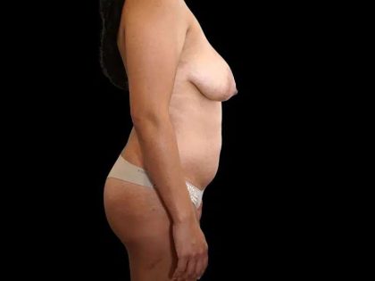 Mommy Makeover Before & After Patient #485