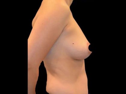 Breast Augmentation Before & After Patient #499