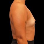 Breast Augmentation Before & After Patient #506