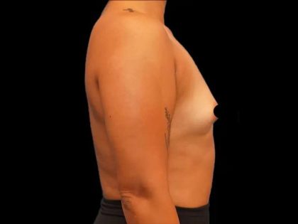 Breast Augmentation Before & After Patient #506