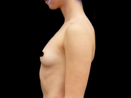 Breast Augmentation Before & After Patient #513