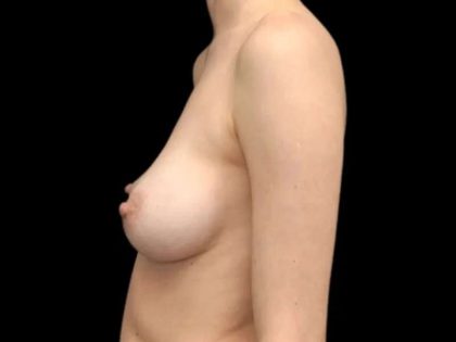 Breast Augmentation Before & After Patient #532