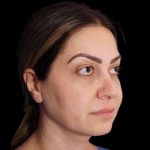 Rhinoplasty Before & After Patient #274