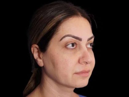 Rhinoplasty Before & After Patient #274
