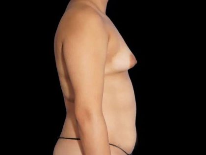 Breast Augmentation Before & After Patient #553