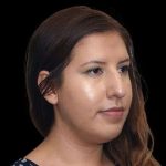 Rhinoplasty Before & After Patient #284