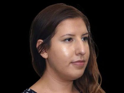 Rhinoplasty Before & After Patient #284