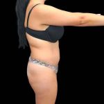 Brazilian Butt Lift Before & After Patient #311