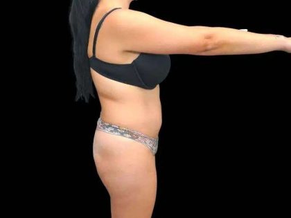 Brazilian Butt Lift Before & After Patient #311