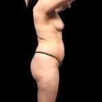 Brazilian Butt Lift Before & After Patient #318