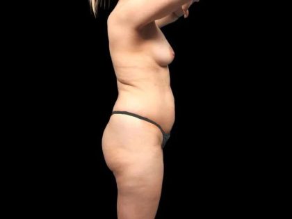 Brazilian Butt Lift Before & After Patient #318