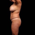 Brazilian Butt Lift Before & After Patient #325