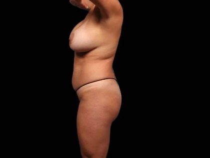 Brazilian Butt Lift Before & After Patient #325