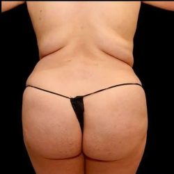 Liposuction Before & After Patient #464