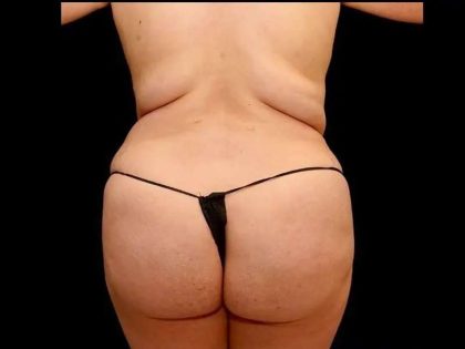 Liposuction Before & After Patient #464