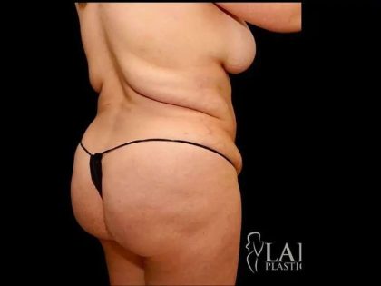 Liposuction Before & After Patient #464