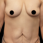 Tummy Tuck Before & After Patient #1555