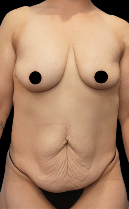 Tummy Tuck Before & After Patient #1555