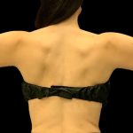 Arm Liposuction Before & After Patient #1591