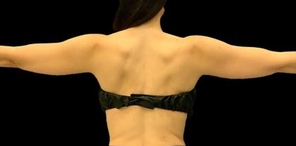 Arm Liposuction Before & After Patient #1591