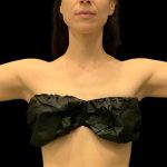 Arm Liposuction Before & After Patient #1591
