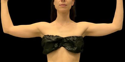Arm Liposuction Before & After Patient #1591