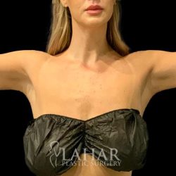 Arm Liposuction Before & After Patient #1590