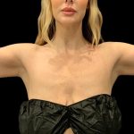 Arm Liposuction Before & After Patient #1590