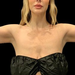 Arm Liposuction Before & After Patient #1590