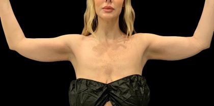 Arm Liposuction Before & After Patient #1590
