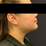 Chin Liposuction Before & After Patient #1556
