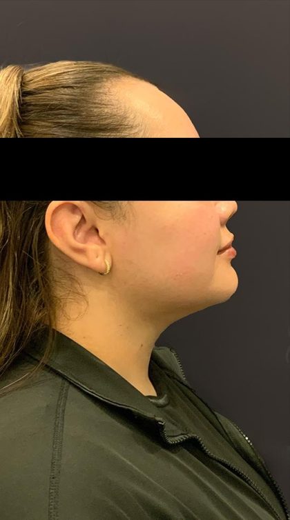 Chin Liposuction Before & After Patient #1556