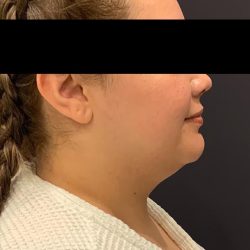 Chin Liposuction Before & After Patient #1556