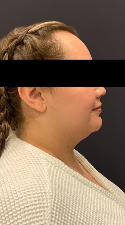 Chin Liposuction Before & After Patient #1556