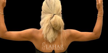 Arm Liposuction Before & After Patient #1592
