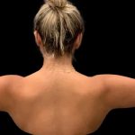 Arm Liposuction Before & After Patient #1592