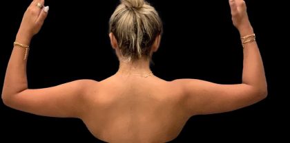 Arm Liposuction Before & After Patient #1592