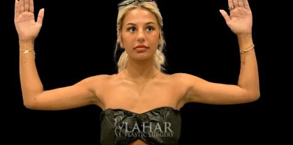 Arm Liposuction Before & After Patient #1592
