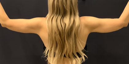 Arm Liposuction Before & After Patient #1590