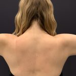 Arm Liposuction Before & After Patient #1590