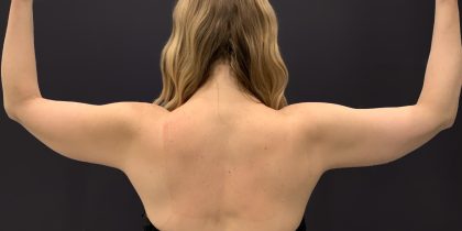 Arm Liposuction Before & After Patient #1590