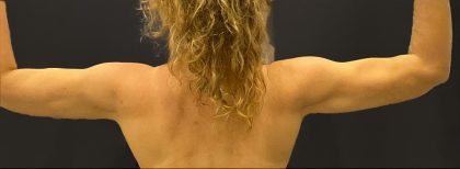 Arm Liposuction Before & After Patient #1582