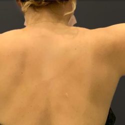Arm Liposuction Before & After Patient #1582