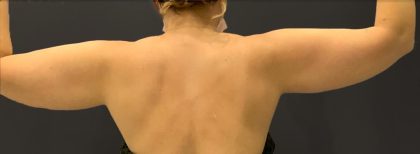 Arm Liposuction Before & After Patient #1582