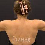 Arm Liposuction Before & After Patient #1583